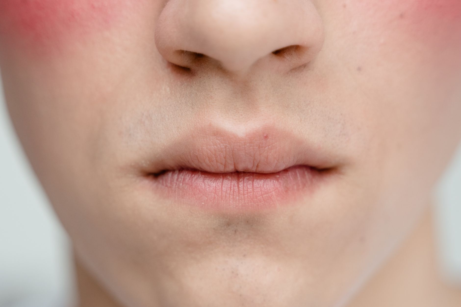 Rosacea & Sensitive Skin — Clearbrook Skin & Dermatology Singapore