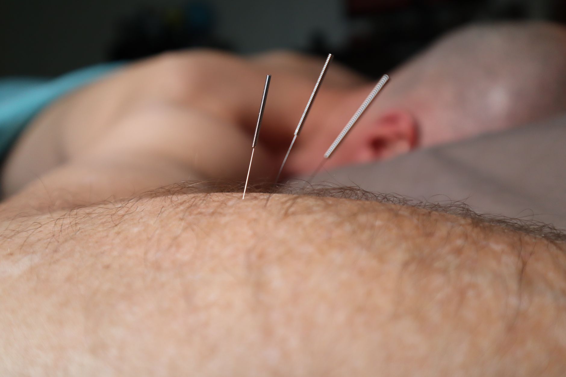 Acupuncture (针灸) at Jadewell TCM, Singapore