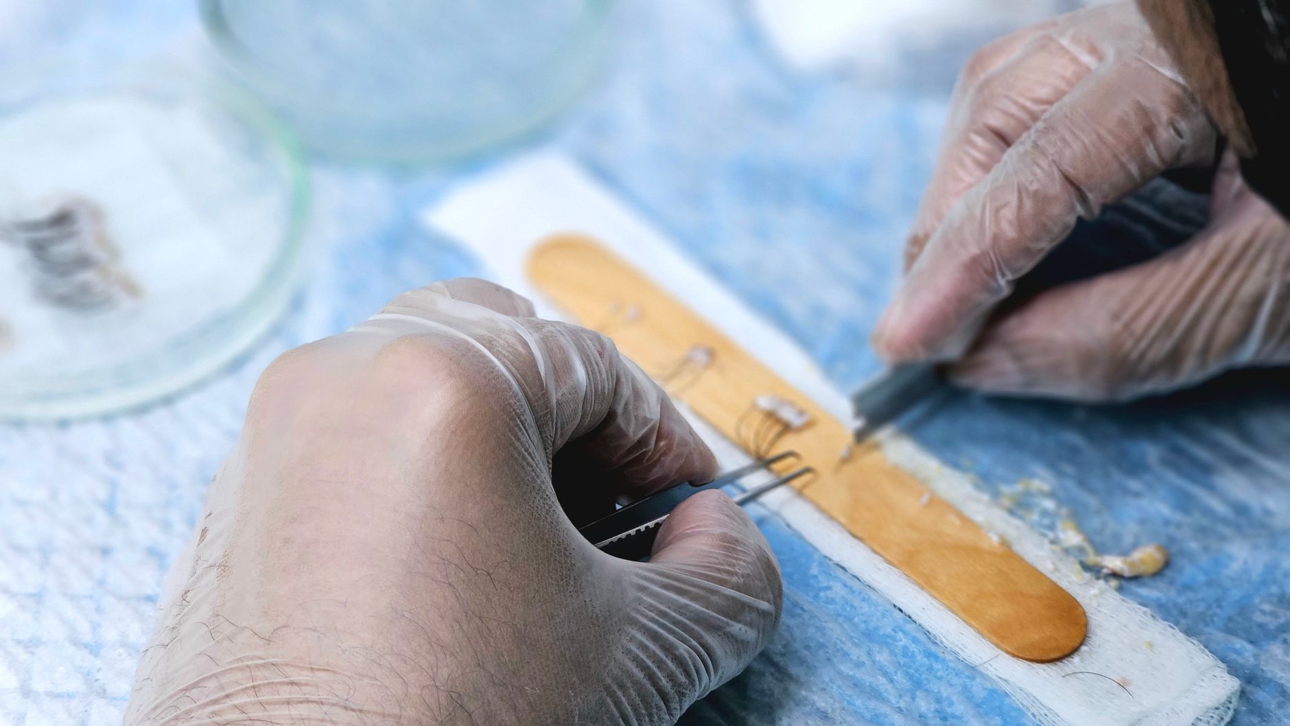FUE Hair Transplant